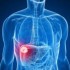 Cancerul ficatului, tumora hepatica la ficat